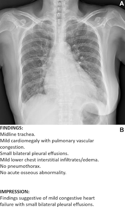 Example of an acceptable AI–generated chest x-ray report. (A) Anteroposterior chest x-ray in a 68-year-old female patient who visited the emergency department because of acute-onset dyspnea shows an enlarged heart, bilateral pleural effusion, and bilateral interstitial thickening, suggesting heart failure and interstitial pulmonary edema. (B) The AI-generated report appropriately describes the findings of the x-ray and suggests a possible diagnosis. All seven thoracic radiologists evaluated the AI-generated report as acceptable without revision.