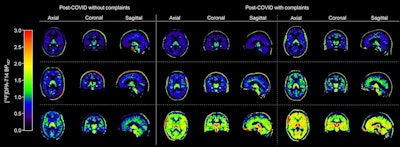 Examples of quantitative cerebral F-18 DPA-714 images of brain in post-COVID individuals. *Parametric Logan VT images corrected for K1/k2 (global cerebral region; gray and white matter) and subtracted by 1, creating indirect BPND images. VT = total distribution volume.