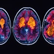 Neuroimaging Brain Pet Scan