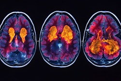 Neuroimaging Brain Pet Scan