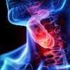 Throat Cancer 3 D