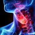 Throat Cancer 3 D