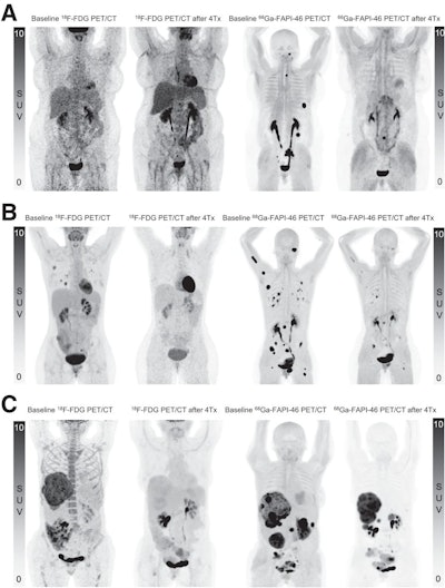 Maximum-intensity-projection images at baseline and follow-up F-18 FDG-PET/CT and Ga-68 FAPI-PET/CT after 4 cycles (4Tx) of Y-90 FAPI-46 for patients A (A), B (B), and C (C).