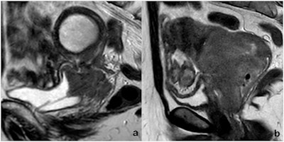 Two cases of MRI-defined bladder wall invasion on sagittal FSE T2-weighted images. (a) A complete loss of neoplasm-bladder cleavage plan, a massive bladder wall thickening with intermediate signal intensity, as well as endoluminal tumor growth, is appreciable; a DJ catheter was placed because of hydronephrosis. (b) An incomplete loss of neoplasm-bladder cleavage plan and a discrete bladder wall thickening with intermediate signal intensity is appreciable, but no endoluminal tumor growth can be observed. The first case was positive at cystoscopy, whereas the second one was negative. Both patients underwent local tumor recurrence (13 and 19 months after chemoradiation, respectively), and both died (25 and 36 months after initial diagnosis, respectively).