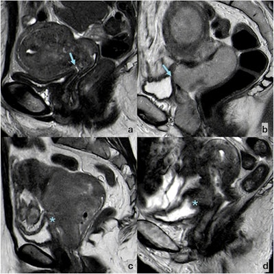 Sagittal T2-weighted FSE images showing the possible appearances of bladder wall–cervical cancer relation. (a) A fatty cleavage plane (arrow) may be observed between CC and the bladder, which shows a thin T2-hypointense wall. (b) The fatty cleavage plane between CC and the bladder is obliterated (arrow), but the bladder wall appears thin and T2-hypointense. (c) The fatty cleavage plane between CC and the bladder is obliterated, and the bladder wall appears thickened, with intermediate signal intensity (star). (d) The fatty cleavage plane between CC and the bladder is obliterated, the bladder wall appears thickened, with intermediate signal intensity, and neoplastic tissue protrudes in the bladder lumen (*).
