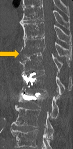 Unstable T11 fracture in a stiff spine in a 92-year-old osteoporotic patient (arrow). The patient had a history of cementoplasty of L1 and L2.