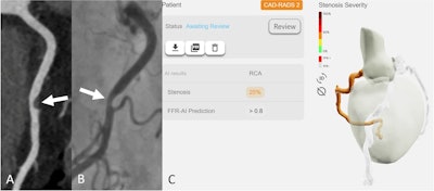 True-negative case. A representative case of a 60-year-old female patient with a recent onset of stable chest pain. Curved multiplanar reconstruction coronary computed tomography angiography (A) shows a soft plaque at the middle portion of the right coronary artery with obstructive stenosis (white arrow). Invasive coronary angiography (B) confirms a 26%–50% stenosis (white arrow). The Fractional Flow Reserve measurement was 0.94, which is above the 0.8 threshold. Instantaneous wave-Free Ratio measurement was 0.95, which is above the 0.89 threshold. The CT-FFRAI prediction was > 0.8 (C).