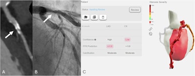 False-positive case. A representative case of an 81-year-old male patient with a recent onset of stable chest pain. Curved multiplanar reconstruction coronary computed tomography angiography (A) shows a heavily calcified plaque with blooming artifacts (white arrow) in the proximal left anterior descending artery with obstructive stenosis. Invasive coronary angiography (B) demonstrates a 26%-50% stenosis, and Fractional Flow Reserve was 0.89, in contrast to the report of CT-FFRAI that predicts FFR ≤ 0.8 (C). Of note, the patient also had an obstructive stenosis on the left circumflex artery with CT-FFRAI > 0.8 prediction and invasive Fractional Flow Reserve > 0.8 (FFR = 0.91).