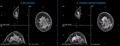 Dedicated breast CT acquisitions of a 44-year-old woman with newly diagnosed invasive ductal carcinoma (IDC) of high aggressiveness (grade 3) in the right breast. (a.) Multiplanar reconstruction of the precontrast acquisition (t = 0 seconds); (b.) Multiplanar reconstruction of the first acquired postcontrast timepoint (t = 90 seconds), indicating the enhancing malignant lesion (purple arrow), in a case with strong background parenchymal enhancement (BPE). Courtesy of Dr. Ritse Mann, NKI, Netherlands Cancer Institute.