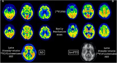 FDG, early perfusion amyloid-PET, and late standard amyloid-PET in a patient with Alzheimer’s disease (AD) ([F-18] Flutemetamol, panel A) and in a patient with behavioral variant of fronto-temporal dementia (bvFTD) ([F-18] Florbetaben, panel B). Regardless of the disease-related pattern (posterior in patient A and anterior in patient B), FDG and early perfusion imaging show largely overlapping distribution with small differences. Higher early-phase amyloid tracer distribution with respect to FDG uptake is expected in the brain stem, cerebellum, anterior cingulate, and thalamus, while lower uptake compared to FDG is present in the prefrontal, orbitofrontal, posterior parietal, and superior temporal regions.