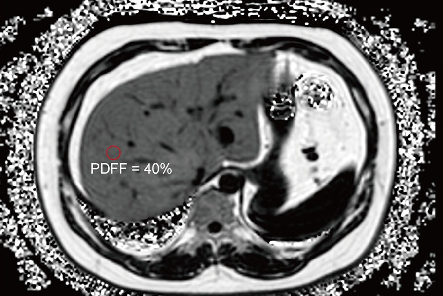 2025 10 21 Liver Mri Derived Proton Density Fat Fraction Thumbnail
