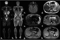 Sequences included in the study MRI protocol: (a) coronal TIRM (turbo inversion recovery magnitude) sequence, (b) coronal T1-weighted sequence, (c) axial FLAIR (fluid-attenuated inversion recovery) sequence (head only), (d) axial T2-weighted fast spin-echo sequence (HASTE), (e) axial diffusion-weighted imaging (b-value 900), (f) an axial ADC map, (g) axial T1-Dixon water-only images before contrast agent, and (h) after administration of contrast agent.