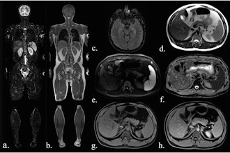 Sequences included in the study MRI protocol: (a) coronal TIRM (turbo inversion recovery magnitude) sequence, (b) coronal T1-weighted sequence, (c) axial FLAIR (fluid-attenuated inversion recovery) sequence (head only), (d) axial T2-weighted fast spin-echo sequence (HASTE), (e) axial diffusion-weighted imaging (b-value 900), (f) an axial ADC map, (g) axial T1-Dixon water-only images before contrast agent, and (h) after administration of contrast agent.
