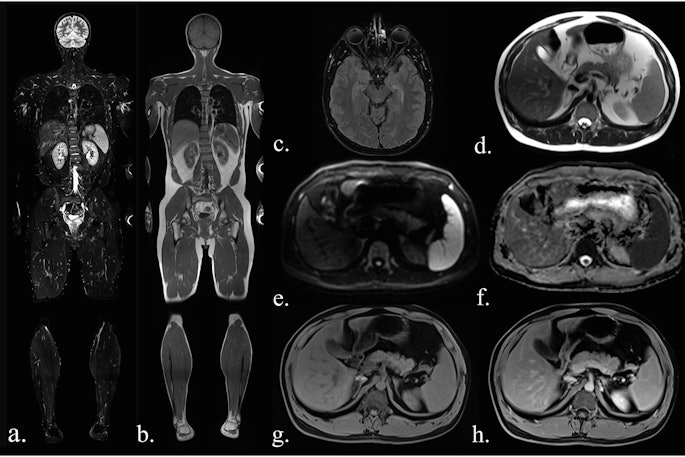 Sequences included in the study MRI protocol: (a) coronal TIRM (turbo inversion recovery magnitude) sequence, (b) coronal T1-weighted sequence, (c) axial FLAIR (fluid-attenuated inversion recovery) sequence (head only), (d) axial T2-weighted fast spin-echo sequence (HASTE), (e) axial diffusion-weighted imaging (b-value 900), (f) an axial ADC map, (g) axial T1-Dixon water-only images before contrast agent, and (h) after administration of contrast agent.