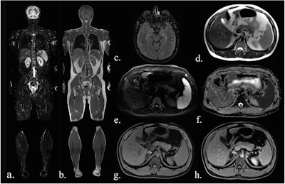Sequences included in the study MRI protocol: (a) coronal TIRM (turbo inversion recovery magnitude) sequence, (b) coronal T1-weighted sequence, (c) axial FLAIR (fluid-attenuated inversion recovery) sequence (head only), (d) axial T2-weighted fast spin-echo sequence (HASTE), (e) axial diffusion-weighted imaging (b-value 900), (f) an axial ADC map, (g) axial T1-Dixon water-only images before contrast agent, and (h) after administration of contrast agent.