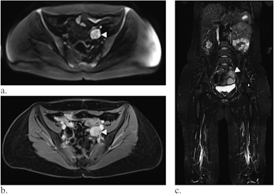 Whole-body MRI of a 39-year-old woman with LFS showing a mass in the small pelvis (white arrow) in diffusion-weighted imaging (a) and contrast-enhanced T1-weighted Dixon images (b, here: water-only image). In the coronal TIRM-sequence (c), the mass is visible, but difficult to differentiate from the intestine, emphasizing the value of diffusion-weighted imaging. Histology revealed a leiomyosarcoma.