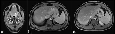 Examples of false-positive findings: Contrast-enhancement in the T1 Dixon water-only image of the pharyngeal wall (white arrow in a) was confirmed as regular hyperplastic pharyngeal tissue on biopsy. A focal contrast-enhancement of the gastric wall (white arrow in b) was no longer detectable on follow-up MRI (c) and was retrospectively deemed an artifact.