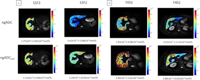 Representative parametric maps of ngADC (at the top) and ngADCcorr (at the bottom); (a) The effect of steatosis is depicted in two patients with identical F2 fibrosis stage but varying steatosis grade; (b) The effect of fibrosis is depicted in two patients with identical steatosis grade (S2) but varying fibrosis stage. In the uncorrected coefficient map, differences of ngADC are seen for steatosis (1.77 × 10-3 vs. 0.62 × 10-3 mm2/s), while in the corrected coefficient map, differences of ngADCcorr are seen for fibrosis (2.93 × 10-3 vs. 1.88 × 10-3 mm2/s). Images and caption courtesy of the JMRI.