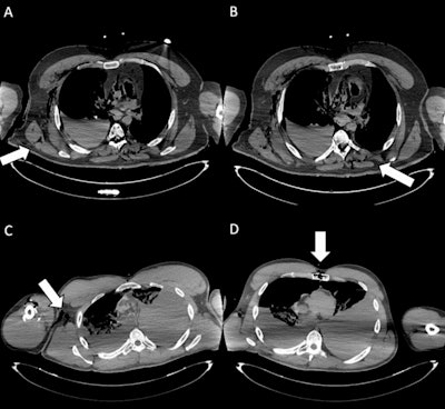 Entry wounds. (A) Axial CT scan shows an entrance wound in the right posterior thoracic wall (white arrow), with adjacent soft-tissue disruption and subcutaneous gas, consistent with a penetrating gunshot injury. (B) Axial CT image depicts the ballistic trajectory with paravertebral left soft-tissue damage (white arrow) and subcutaneous emphysema in the posterior right chest wall. (C) Cross-sectional CT slice demonstrates an entrance wound at the root of the right arm (white arrow), associated with soft-tissue laceration and subcutaneous emphysema. (D) CT image illustrates an entrance wound at the sternal level (white arrow), with anterior chest wall disruption and surrounding soft-tissue alterations, compatible with penetrating trauma. The identification of entrance gunshot wounds showed only moderate inter-reader agreement (Fleiss’ kappa = 0.55). In particular, less forensic-experienced readers demonstrated markedly reduced sensitivity (29.7%), highlighting the diagnostic challenges of detecting these findings on postmortem CT.
