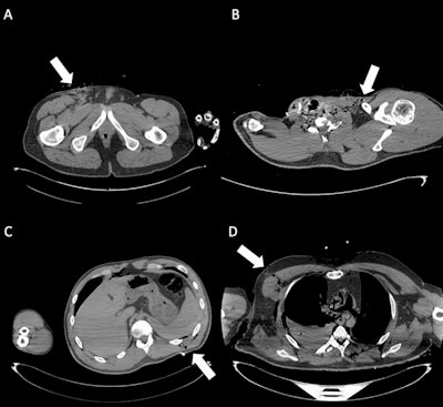 Exit wounds. (A) Axial CT scan shows an exit wound in the subcutaneous soft tissues at the root of the right thigh (white arrow). (B) Axial CT image depicts an exit wound in the left supraclavicular region (white arrow), visible as a focal soft-tissue defect with surrounding gas bubbles. (C) Cross-sectional CT slice illustrates an exit wound at the left posterior abdominal wall (white arrow), with subcutaneous emphysema and adjacent soft-tissue disruption. (D) CT image demonstrates an exit wound in the right chest region (white arrow), characterized by soft-tissue laceration and subcutaneous gas. Exit gunshot wounds were associated with the lowest inter-reader agreement (Fleiss’ kappa = 0.36). Despite the very high specificity of virtopsy, sensitivity was particularly low among readers without forensic experience (12.5% and 16.7%), underlining the difficulty in correctly identifying these injuries on postmortem CT.