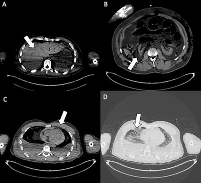 Organ injuries. (A) Axial CT scan shows traumatic injury to the bi-lobar liver parenchyma (white arrow). Moderate postmortem decomposition is also evident, with heterogeneous intraparenchymal gas distribution. (B) Cross-sectional CT image demonstrates a laceration of the right kidney (white arrow), consistent with penetrating trauma. (C) Axial CT slice shows a pericardial lesion (white arrow), with small gas bubbles in the anterior pericardial region, indicative of traumatic pericardial injury. (D) CT image highlights a laceration of the right middle lobe (white arrow), associated with pulmonary contusion, omolateral pneumothorax, and bilateral pleural effusion. In the assessment of organ injuries, inter-reader agreement was only moderate (Fleiss’ kappa = 0.52). Sensitivity was again limited among less forensic-experienced readers (31% and 51.7%), reflecting the interpretative complexity and reduced diagnostic accuracy of postmortem CT in this setting.