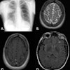 58-year-old woman. (A.) CXR frontal: right upper lobe focus of consolidation. (B.) MR Brain axial T2: round lesion of right parietal lobe that is hyperintense. Left frontal lobe lesion that is also hyperintense. (C.) MR Brain axial T1 + contrast: right parietal lobe lesion demonstrating peripheral enhancement. (D.) MR Brain axial FLAIR: round lesion of the right thalamus, which is hypointense.