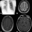 58-year-old woman. (A.) CXR frontal: right upper lobe focus of consolidation. (B.) MR Brain axial T2: round lesion of right parietal lobe that is hyperintense. Left frontal lobe lesion that is also hyperintense. (C.) MR Brain axial T1 + contrast: right parietal lobe lesion demonstrating peripheral enhancement. (D.) MR Brain axial FLAIR: round lesion of the right thalamus, which is hypointense.