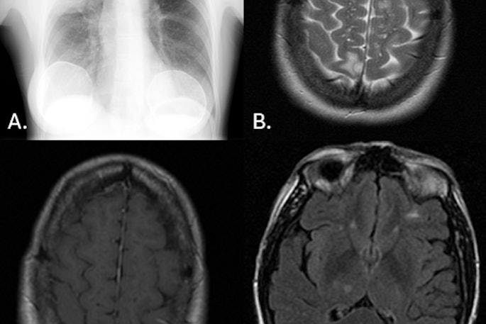 58-year-old woman. (A) CXR frontal: right upper lobe focus of consolidation. (B) MR Brain axial T2: round lesion of right parietal lobe that is hyperintense. Left frontal lobe lesion that is also hyperintense. (C) MR Brain axial T1 + contrast: right parietal lobe lesion demonstrating peripheral enhancement. (D) MR Brain axial FLAIR: round lesion of the right thalamus, which is hypointense.
