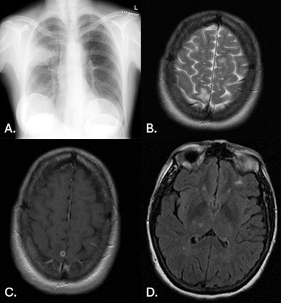 58-year-old woman. (A) CXR frontal: right upper lobe focus of consolidation. (B) MR Brain axial T2: round lesion of right parietal lobe that is hyperintense. Left frontal lobe lesion that is also hyperintense. (C) MR Brain axial T1 + contrast: right parietal lobe lesion demonstrating peripheral enhancement. (D) MR Brain axial FLAIR: round lesion of the right thalamus, which is hypointense.