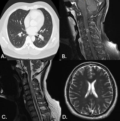 41-year-old man. (A.) CT Chest axial: peribronchovascular lesions within the superior segment of the left upper lobe. (B.) MR C Spine sagittal T1 contrast fat sat: round lesion at the level of C3 with peripheral hyperintensity. (C.) MR C Spine sagittal T2: thick-walled lesion at the level of C3 within the cervical spine with central hyperintensity. (D.) MR Brain axial T2: small lesion of the left frontal lobe that is hyperintense with leptomeningeal enhancement. There is also associated mild cortical edema.