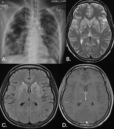 26-year-old woman. (A.) CXR frontal: bilateral, patchy consolidation consistent with pneumonia. (B.) MR brain axial T2: extensive, small hyperintense lesions involving the basal ganglia. This is consistent with engorged and dilated perivascular spaces, which is consistent with pseudocyst formation. (C.) MR brain axial FLAIR: extensive, small hyperintense lesions involving the basal ganglia. (D.) MR brain axial T1 + contrast: there is no contrast enhancement of the lesions demonstrated on T2 and FLAIR imaging.