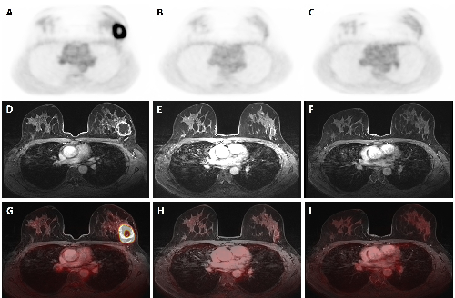 Dedicated breast F-18 FDG PET/MRI exam pre- (A, D, G), mid- (B, E, H), and post-NAC (C, F, I) of a 41-year-old patient diagnosed with a triple negative (TN), grade 2, invasive carcinoma. The SUVmax values of the primary tumor were 14.68 pre-NAC, 1.69 mid-NAC, and 1.87 post-NAC, while SER values were 1.19, 0.52, and 0.63, respectively. Figure courtesy of Melissa Lenaerts, PhD, Dr. Thiemo van Nijnatten, PhD, et al and presented at EUSOBI 2025.