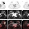 Dedicated breast F-18 FDG PET/MRI exam pre- (A, D, G), mid- (B, E, H), and post-NAC (C, F, I) of a 41-year-old patient diagnosed with a triple negative (TN), grade 2, invasive carcinoma. The SUVmax values of the primary tumor were 14.68 pre-NAC, 1.69 mid-NAC, and 1.87 post-NAC, while SER values were 1.19, 0.52, and 0.63, respectively. Figure courtesy of Melissa Lenaerts, PhD, Dr. Thiemo van Nijnatten, PhD, et al and presented at EUSOBI 2025.