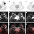 Dedicated breast F-18 FDG PET/MRI exam pre- (A, D, G), mid- (B, E, H), and post-NAC (C, F, I) of a 41-year-old patient diagnosed with a triple negative (TN), grade 2, invasive carcinoma. The SUVmax values of the primary tumor were 14.68 pre-NAC, 1.69 mid-NAC, and 1.87 post-NAC, while SER values were 1.19, 0.52, and 0.63, respectively. Figure courtesy of Melissa Lenaerts, PhD, Dr. Thiemo van Nijnatten, PhD, et al and presented at EUSOBI 2025.