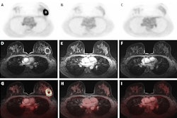 Dedicated breast F-18 FDG PET/MRI exam pre- (A, D, G), mid- (B, E, H), and post-NAC (C, F, I) of a 41-year-old patient diagnosed with a triple negative (TN), grade 2, invasive carcinoma. The SUVmax values of the primary tumor were 14.68 pre-NAC, 1.69 mid-NAC, and 1.87 post-NAC, while SER values were 1.19, 0.52, and 0.63, respectively. Figure courtesy of Melissa Lenaerts, PhD, Dr. Thiemo van Nijnatten, PhD, et al and presented at EUSOBI 2025.