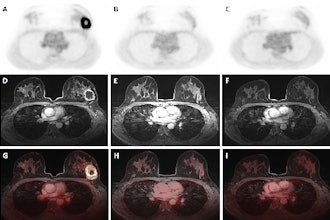 Dedicated breast F-18 FDG PET/MRI exam pre- (A, D, G), mid- (B, E, H), and post-NAC (C, F, I) of a 41-year-old patient diagnosed with a triple negative (TN), grade 2, invasive carcinoma. The SUVmax values of the primary tumor were 14.68 pre-NAC, 1.69 mid-NAC, and 1.87 post-NAC, while SER values were 1.19, 0.52, and 0.63, respectively. Figure courtesy of Melissa Lenaerts, PhD, Dr. Thiemo van Nijnatten, PhD, et al and presented at EUSOBI 2025.