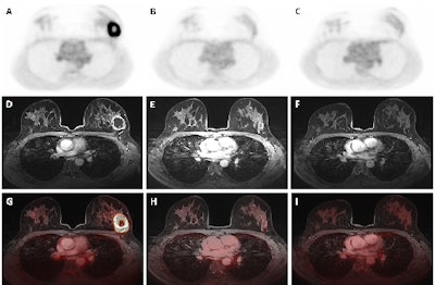 Dedicated breast F-18 FDG PET/MRI exam pre- (A, D, G), mid- (B, E, H), and post-NAC (C, F, I) of a 41-year-old patient diagnosed with a triple negative (TN), grade 2, invasive carcinoma. The SUVmax values of the primary tumor were 14.68 pre-NAC, 1.69 mid-NAC, and 1.87 post-NAC, while SER values were 1.19, 0.52, and 0.63, respectively. Figure courtesy of Melissa Lenaerts, PhD, Dr. Thiemo van Nijnatten, PhD, et al and presented at EUSOBI 2025.