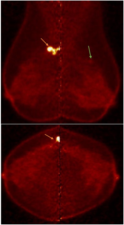PEM detected contralateral malignancy missed in conventional mammography. Notably, there is a quantitative difference in uptake between both lesions, with the uptake of IDC in the right breast higher than ILC in the left breast. All figures courtesy of Dr. Aya Deabes et al and presented at EUSOBI 2025.