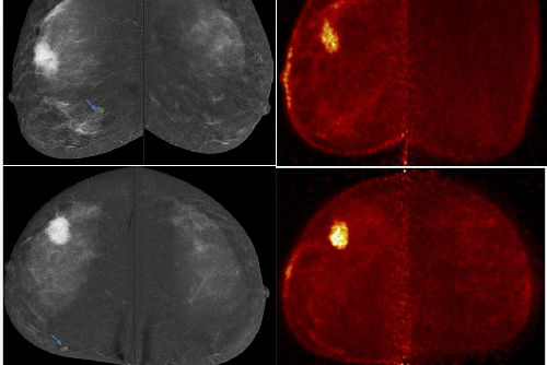 A 399 Fig 2 Pem Vs Cesm E Poster Eusobi 2025 Deabes Thumbnail
