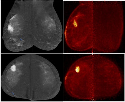 PEM detected multifocality in right breast and excluded multicentricity overestimated by contrast-enhanced mammography (left upper-outer quadrant focal heterogeneous non-mass enhancement was considered suspicious BIRADS-4). Left breast wide local excision revealed sclerosing adenosis and usual ductal hyperplasia. Follow-up revealed no residual suspicious lesions.