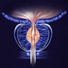 Benign Prostatic Hyperplasia
