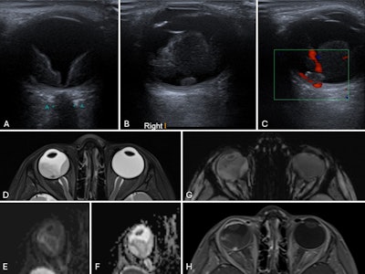 Coats disease in a 3-year-old child. (A) Axial ultrasound of the right eye shows retinal detachment with echogenic subretinal fluid. (B) A small ovoid nodule is seen adjacent to the retina, demonstrating homogeneous echogenicity. (C) Color Doppler imaging shows no internal vascularity within the nodule. (D) Axial T2-weighted MR image of the orbits reveals a slightly small right globe with retinal detachment and subretinal fluid of intermediate signal intensity. The previously identified nodule, located in the foveal region, appears hypointense. (E–F) No evidence of restricted diffusion. (G) Susceptibility-weighted imaging shows no appreciable blooming artifacts to suggest calcification. (H) The lesion demonstrates avid enhancement on post-contrast images. Overall findings are consistent with Coats disease with an enhancing subfoveal nodule.