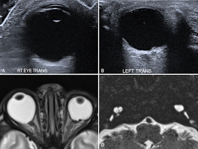 Bilateral coloboma in a 15-day-old neonate with CHARGE syndrome. Ultrasound images of the right eye (A) and left eye (B) show focal defects in the posterior globe with vitreous herniation, suggestive of bilateral colobomas. Axial T2-weighted MR image of the orbits (C) confirms the ultrasound findings. A heavily T2-weighted axial MR image of the petrous temporal bones (D) shows bilaterally dysplastic cochleae and vestibules, with absent semicircular canals -- findings consistent with CHARGE syndrome.
