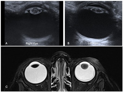 Bilateral congenital cataracts in a 15-day-old infant. Axial ultrasound images of the right lens (A) and left lens (B) demonstrate increased thickness with intralenticular echoes and increased echogenicity of both the anterior and posterior lens walls. (C) Left cataract in a different 2-year-old child with left retinoblastoma. Axial T2-weighted fat-saturated (T2W FS) MRI of the orbits shows globular thickening of the left lens with increased T2 signal compared to the normal right lens, consistent with cataract formation. Additional findings include left retinal detachment and mucosal thickening of the bilateral ethmoid air cells. Attachment of the retinal membrane to the optic disc is not visible in this image. All figures courtesy of Drs. Lasith Ihalagamage, Albert Prat Matifoll, Robert Goetti, and Kristina Prelog and presented at RANZCR's 2025 ASM.