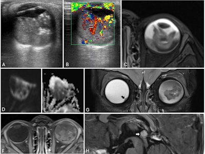 Trilateral retinoblastoma in a 21-month-old child. (A) Axial ultrasound of the left eye shows a solid, heterogeneous mass adherent to the posterior globe wall with echogenic foci suggestive of calcifications. (B) Color Doppler confirms internal vascularity. (C) Axial T2-weighted MRI demonstrates a heterogeneously hypoechoic intraocular lesion with a fluid level. (D-E) The mass is hyperintense on diffusion-weighted imaging and hypointense on the apparent diffusion coefficient (ADC) map, consistent with restricted diffusion. (F) Post-contrast images show heterogeneous enhancement. (G) Coronal T2-weighted image reveals a small nodular soft-tissue elevation in the inferomedial right globe (black arrow), indicating bilateral disease. (H) Sagittal post-contrast T1-weighted image demonstrates an enhancing pineal lesion with associated restricted diffusion (not shown), suggestive of a pineoblastoma, consistent with trilateral retinoblastoma.