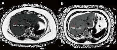 Axial proton density fat fraction (PDFF) maps show hepatic steatosis assessment in patients with dysglycemia. (A) PDFF map in a 27-year-old female patient (body mass index [BMI; calculated as weight in kilograms divided by height in meters squared] = 38.9) with a 1-year history of obesity and metabolic syndrome, and hospital-confirmed prediabetes. The image shows moderate hepatic steatosis (mean liver PDFF, 19%; circle). (B) PDFF map in a 40-year-old male patient (BMI = 33.35) with a history of obesity, metabolic syndrome, hypertension, and hospital-confirmed type II diabetes. The image shows severe hepatic steatosis (mean liver PDFF, 40%; circle).
