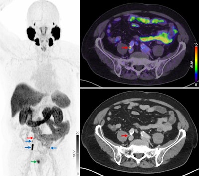 Primary staging of a patient with high-risk prostate cancer. Initial F-18 NaF-PET/CT showed no regional or distant metastases. The patient later underwent radical prostatectomy with extended pelvic lymph-node dissection. In a blinded project review, F-18 PSMA-PET/CT revealed multiple intrapelvic lymph node metastases (blue arrows) and 1 lymph node metastasis near bifurcation of right common iliac artery (red arrows). Primary prostate lesion is also visible (green arrow). Three months postoperatively, the patient’s PSA remained elevated (0.67 ng/mL), and bicalutamide therapy was started.
