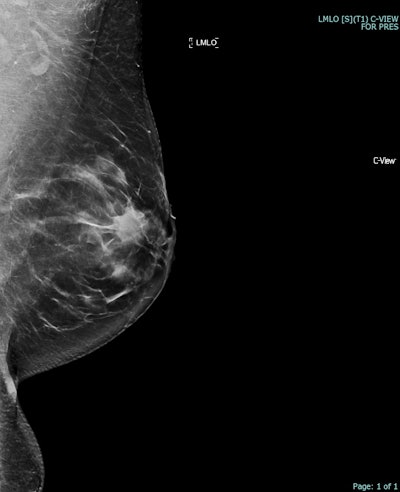 Correlative mammographic, sonographic, and histopathological findings in a 37-year-old woman presenting with a left breast skin abnormality and palpable mass. (a) Synthesized 2D mammogram, left breast, mediolateral oblique (MLO) projection: Spiculated mass density in the upper outer quadrant.