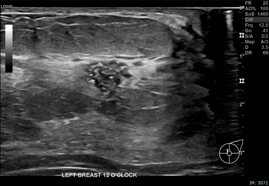 Correlative mammographic, sonographic and histopathological findings in a 29-year-old woman presenting with a palpable left axillary lump, subsequently shown to be accessory breast tissue. (a) Ultrasound, left breast, 12 o&rsquo;clock position: A 10 mm partially irregular hypoechoic lesion with internal calcific foci, located 1 cm from the nipple.