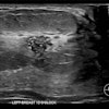 Correlative mammographic, sonographic and histopathological findings in a 29-year-old woman presenting with a palpable left axillary lump, subsequently shown to be accessory breast tissue. (a) Ultrasound, left breast, 12 o’clock position: A 10 mm partially irregular hypoechoic lesion with internal calcific foci, located 1 cm from the nipple.